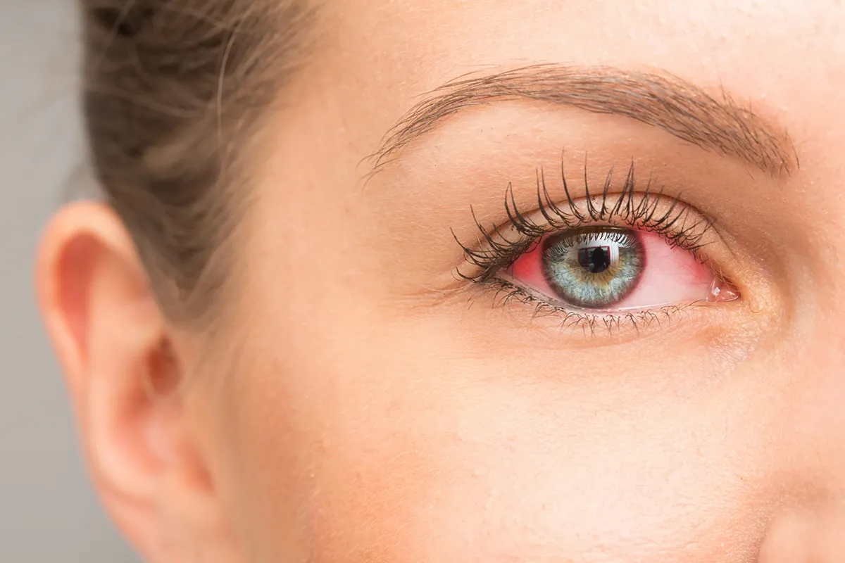 A close up shot of a woman's dry, irritated eye.